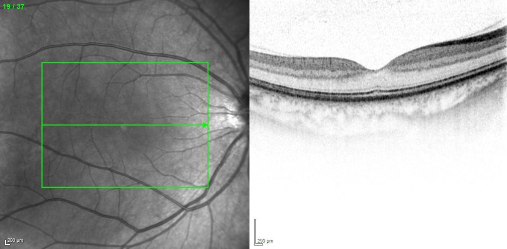 OCT-Bild eines gesunden Auges
